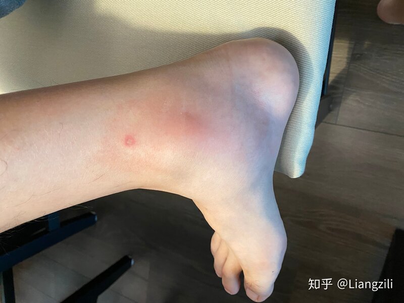 被马蜂蛰了是种什么体验-3.jpg